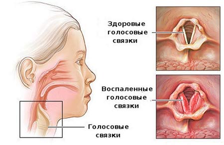 Ларингит: симптомы и лечение у детей