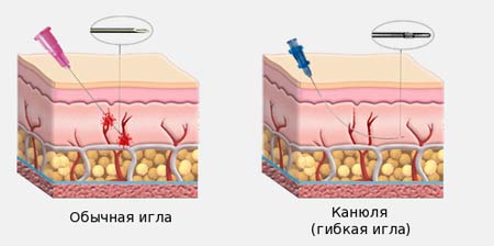 Коррекция носослезной борозды